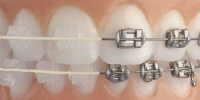 damon clear braces