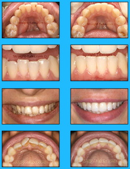 inman aligners before and after